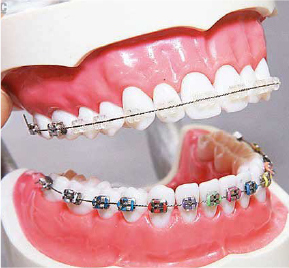 牙齒矯正後該做什麽護理措施呢