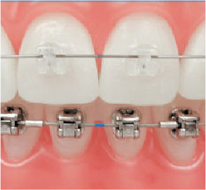 牙齒矯正都有哪些方法？