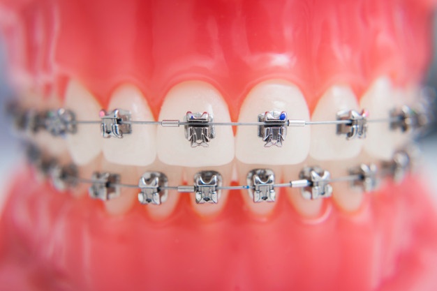 牙齒正畸可能引發的並發症