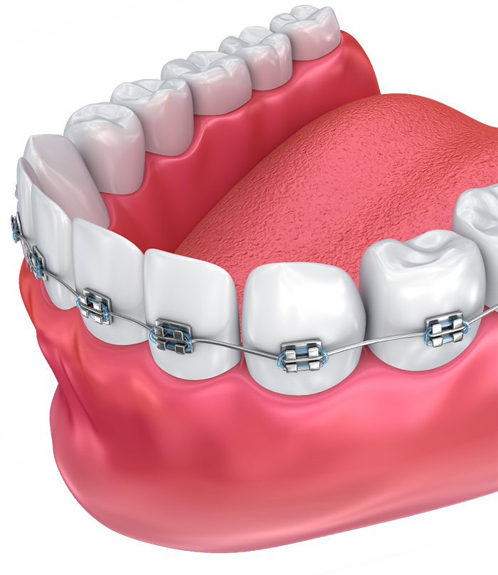 較爲常見的對于牙齒矯正的副作用