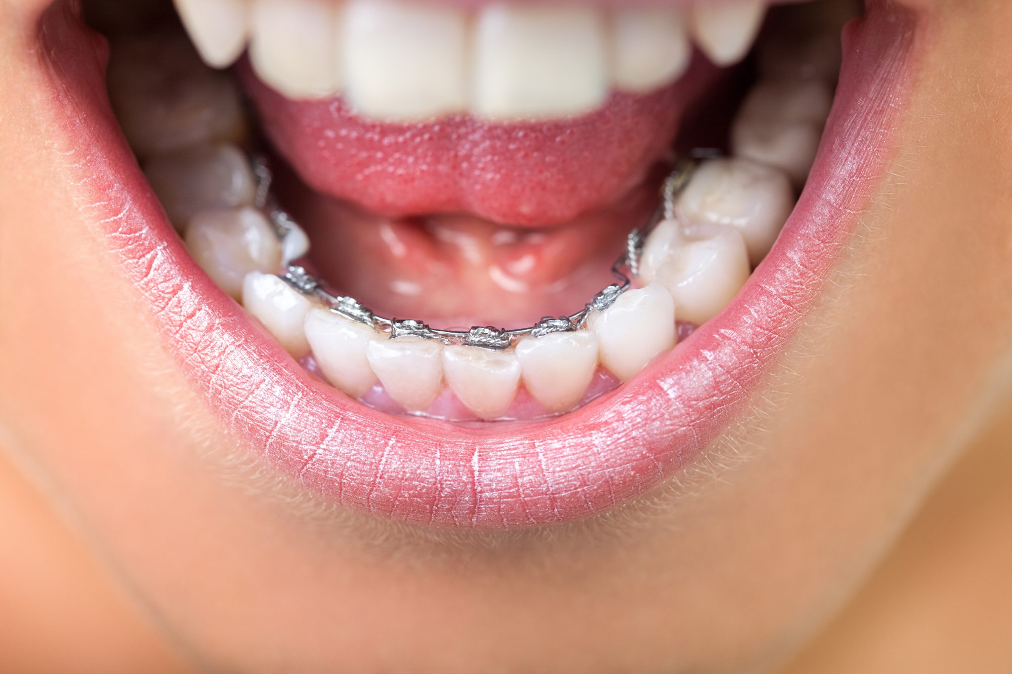 爲什麽一根鋼絲就能矯正牙齒？