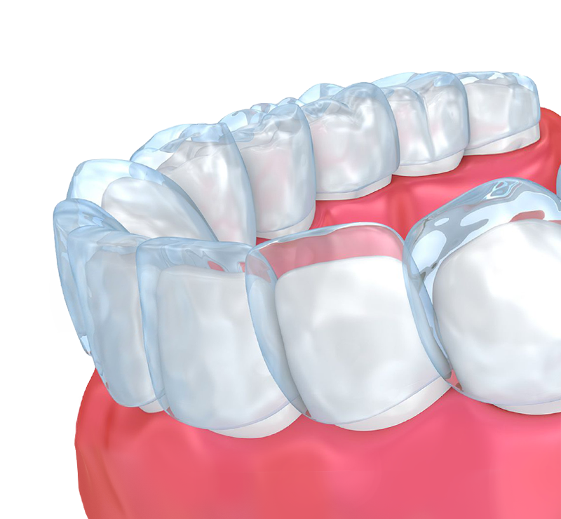 四大常見的牙齒矯正器的介紹