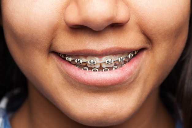 兒童牙齒矯正在什麽年齡治療比較好