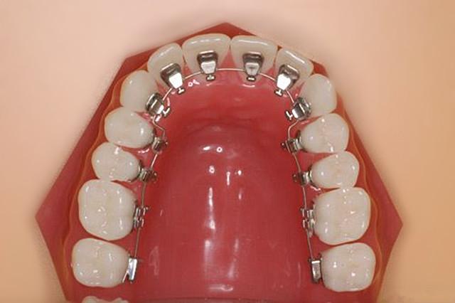 什麽會導致牙齒反合