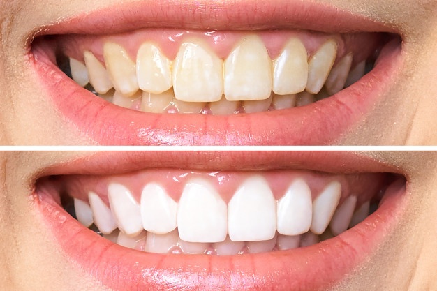 牙齒矯正的三個誤區