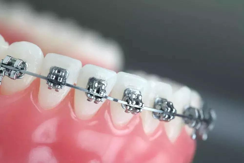 牙齒矯正的危害是什麽
