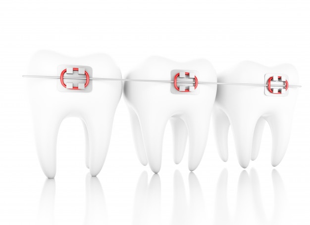 牙齒地包天應該如何矯正？