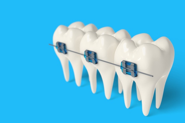 TOMY自鎖矯治技術對非拔牙矯治前牙反牙合伴中度擁擠患者矯治效果1例報告並文獻複習