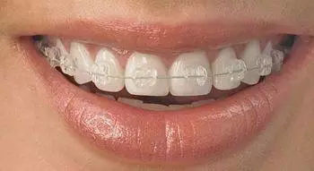 成人牙齒矯正方法專題