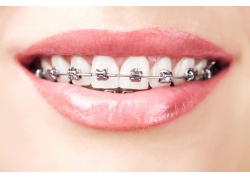 牙齒矯正比較安全的方法