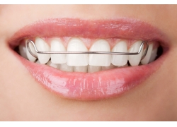 牙齒矯正效果可以維持多久？_1