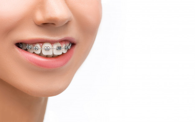 矯牙需求者的疑惑：牙齒矯正是否會使牙齒松動？