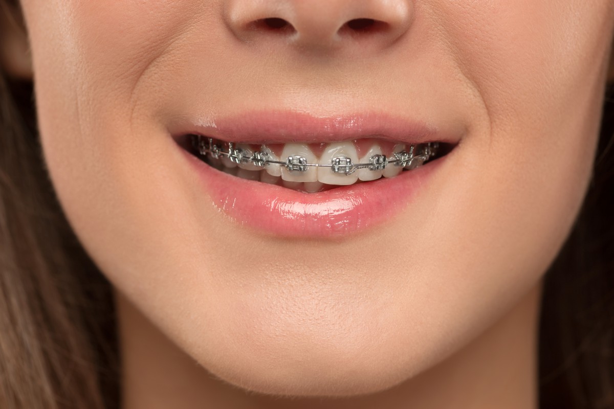 爲什麽有的人牙齒矯正後會牙齒松動呢-