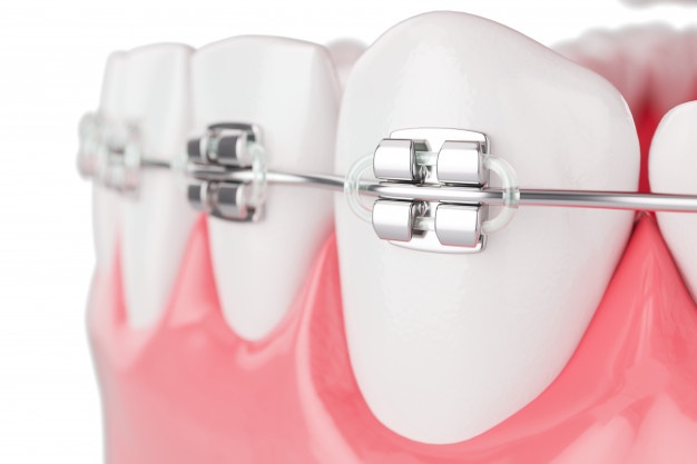 牙齒矯正可以瘦臉？這些正牙誤區你中了幾個？
