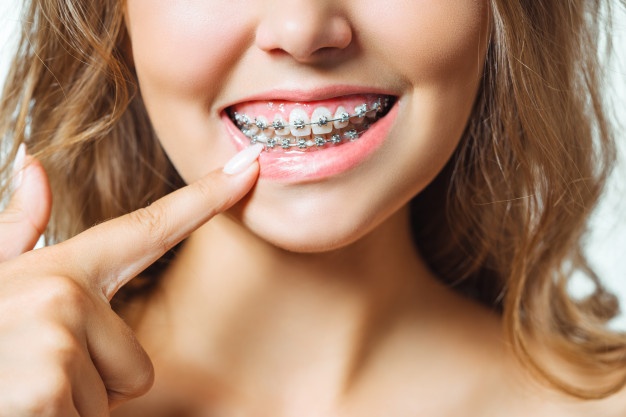 矯正牙齒常用的幾種矯正器對比