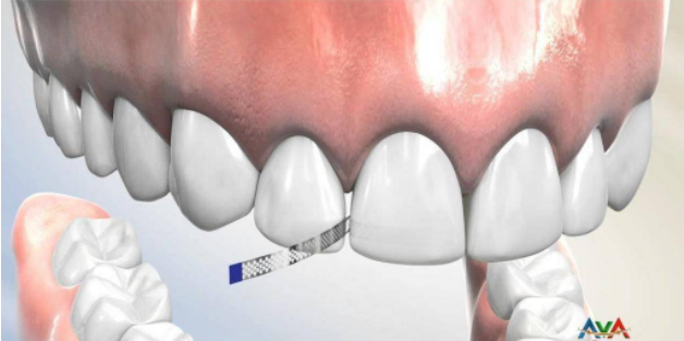箍牙時的片切、擴弓、拔牙、磨牙遠移，到底是什麼？