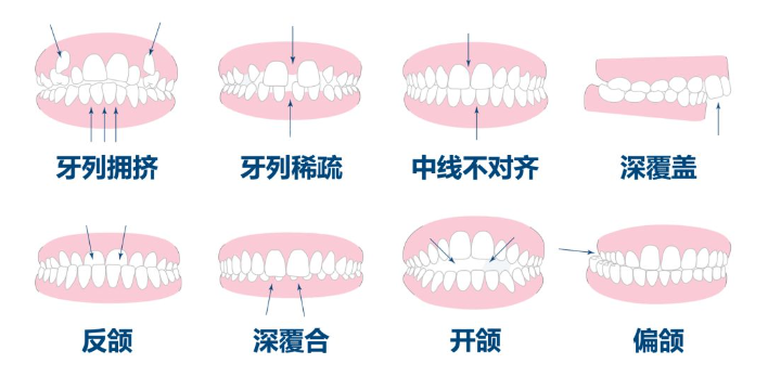 箍牙科普