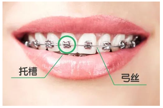 固定牙箍大科普——你不知道的矯正知識