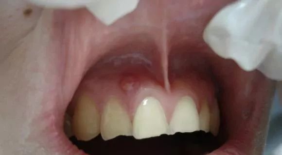 牙龈上長膿包，擠掉後還反複長出，怎麽回事？