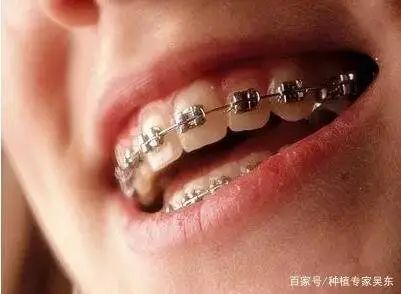 箍牙，剝牙定係唔剝，該點樣選擇？