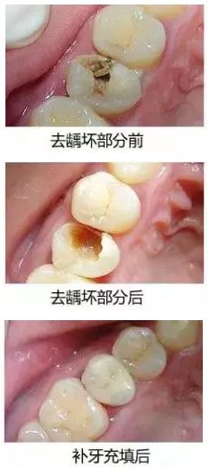 淺齲、中齲補牙就可以了，深齲牙髓炎要怎麽辦？