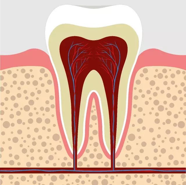 智齒碰上急性牙髓炎，直接拔除還是開髓後拔除？