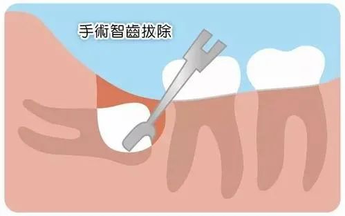 後生仔智慧齒反復發炎，最終導致面部“爛穿”要切開引流！