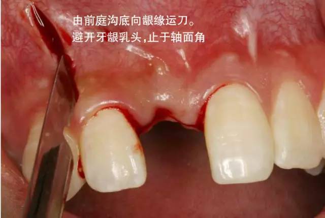 組織切口與瓣嘅設計、翻瓣術切開嘅步驟--口腔種植手術學圖解