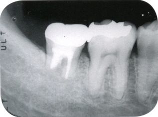圖說拔牙流程，看完後你就不會害怕拔牙啦！