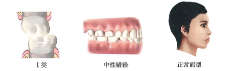 牙齒的咬合方式有幾種？