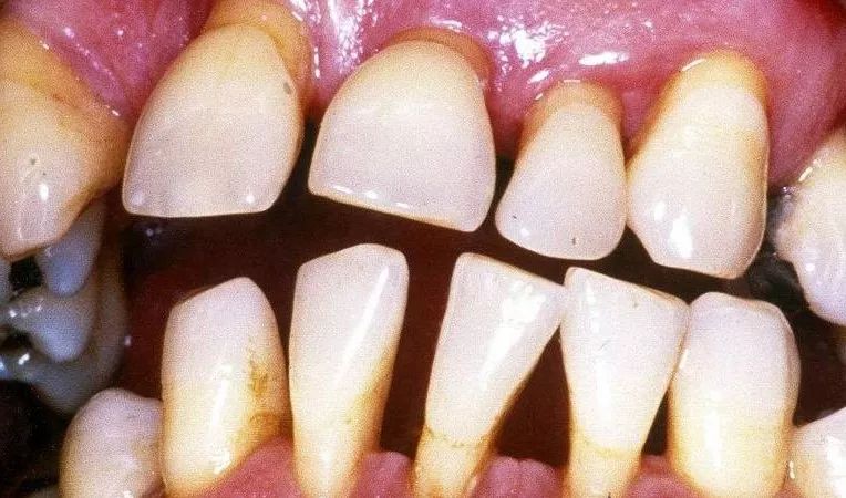 牙齒越長越長？你可能被牙齦萎縮盯上咗！