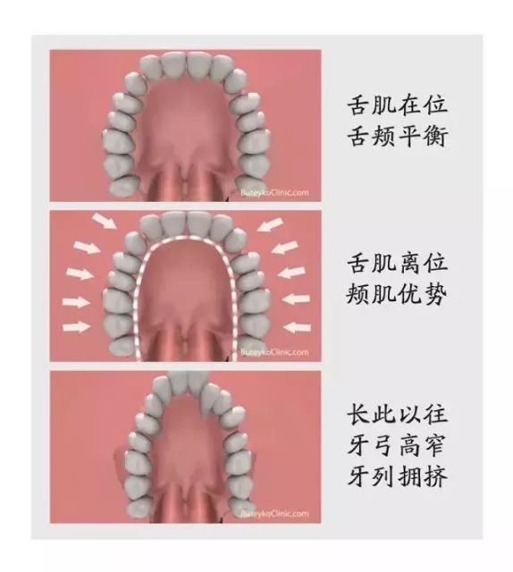 點解牙醫一眼就可以睇出小朋友長期有口呼吸嘅習慣？