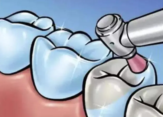 牙齒楔狀缺損怎樣補才能夠牢固