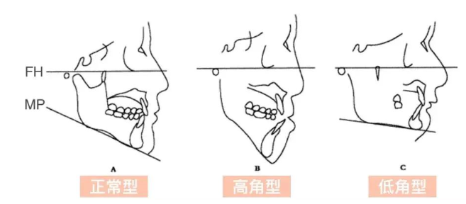 箍牙科普