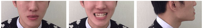 箍牙改變嘴型